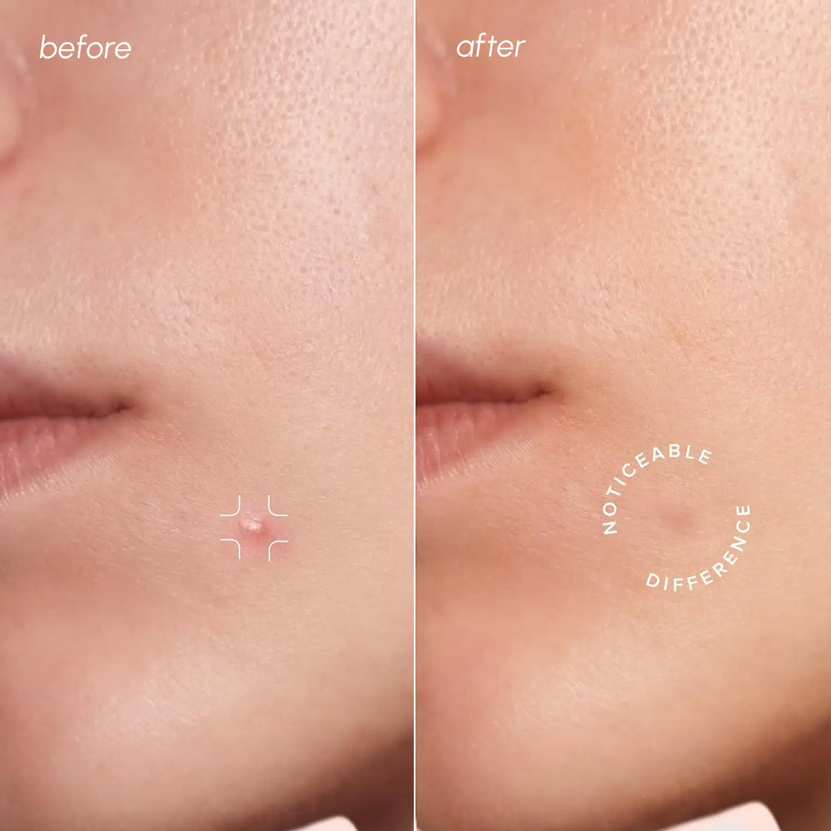 Before and after comparison of a small mole on skin with text 'Noticeable Difference'.