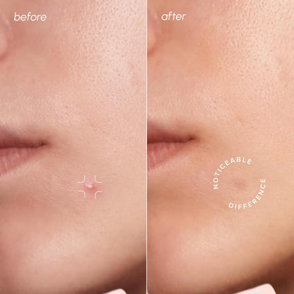 Before and after comparison of a small mole on skin with text 'Noticeable Difference'.
