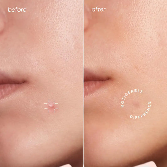 Before and after comparison of a small mole on skin with text 'Noticeable Difference'.