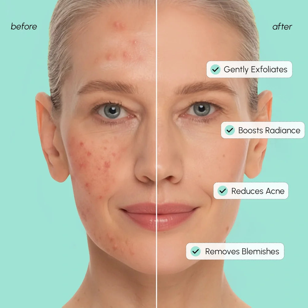 Before-and-after split-screen comparison of a woman's face, showing acne and blemishes on the left side and clearer skin on the right side, with text listing benefits: gently exfoliates, boosts radiance, reduces acne, and removes blemishes, all on a mint green background.