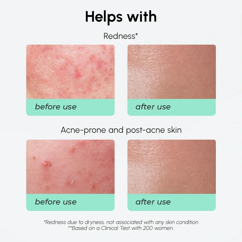 Before and after use comparison of skin redness on acne-prone and post-acne skin.