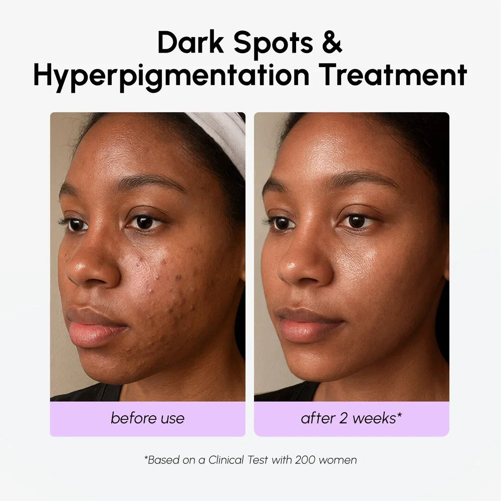 Before and after treatment of dark spots and hyperpigmentation on a woman's face.