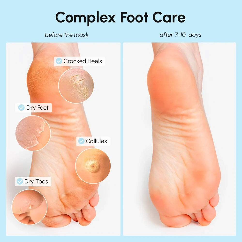 Before-and-after foot care infographic showing a human foot from the sole, with labels for cracked heels, dry feet, calluses, and dry toes, plus text reading 'before the mask' and 'after 7-10 days' under the heading 'Complex Foot Care'.