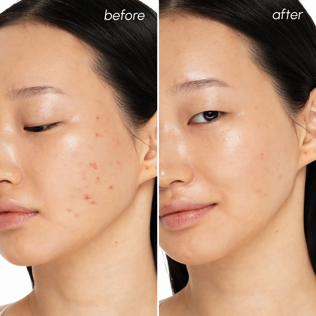 Before and after comparison of a person's face with visible skin improvement.
