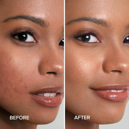 Before and after comparison of a woman's face with visible skin improvement.